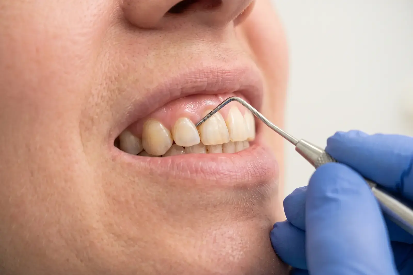 Sonda periodontal midiendo la encía de un paciente adulto